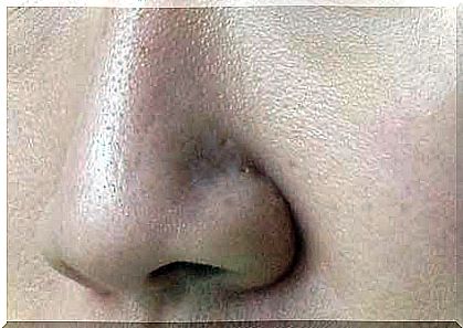 Expanded pores are often noticeable in the nasal area
