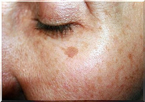 Home remedies for age spots