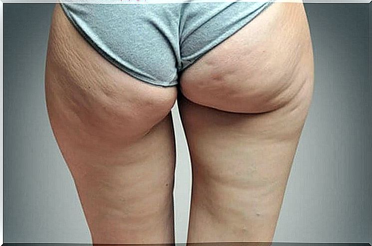 fluid retention can lead to cellulite