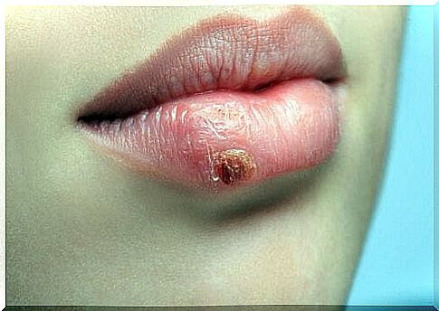 Herpes on the lip