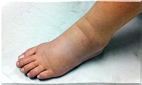 Edema as a sign of renal insufficiency