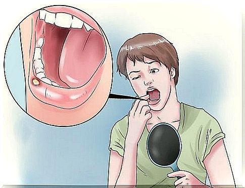 8 natural remedies for mouth ulcers