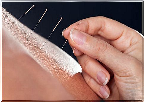 Acupuncture with thin needles