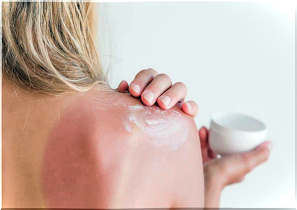 Body lotion or after sun lotion: which is better for sunburn?
