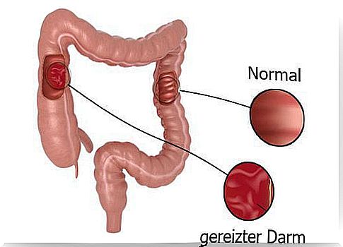 Irritable Bowel Syndrome and How Herbal Remedies Can Help