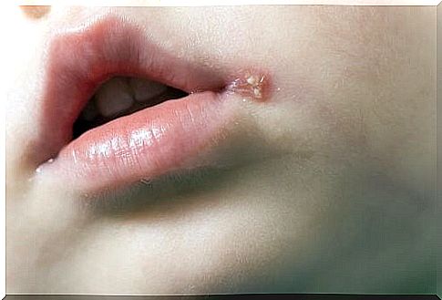 Herpes infection in children