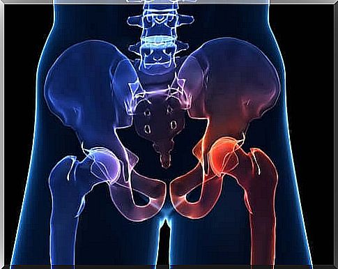 Hip osteoarthritis - features and symptoms