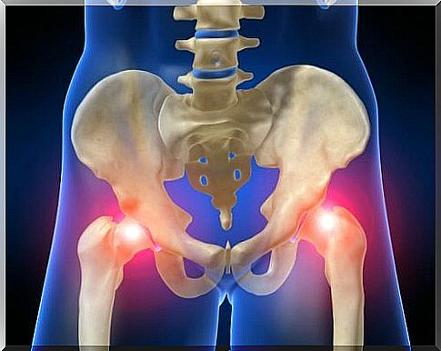 Hip osteoarthritis - image