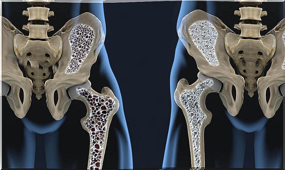 This is how you can prevent osteoporosis in the long term!