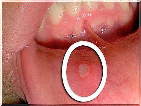 indication-of-oropharyngeal-cancer