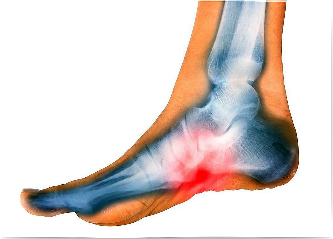 Plantar fasciitis: what is it and how does it help?