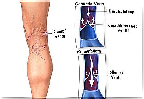 Tips that could help against pain in varicose veins