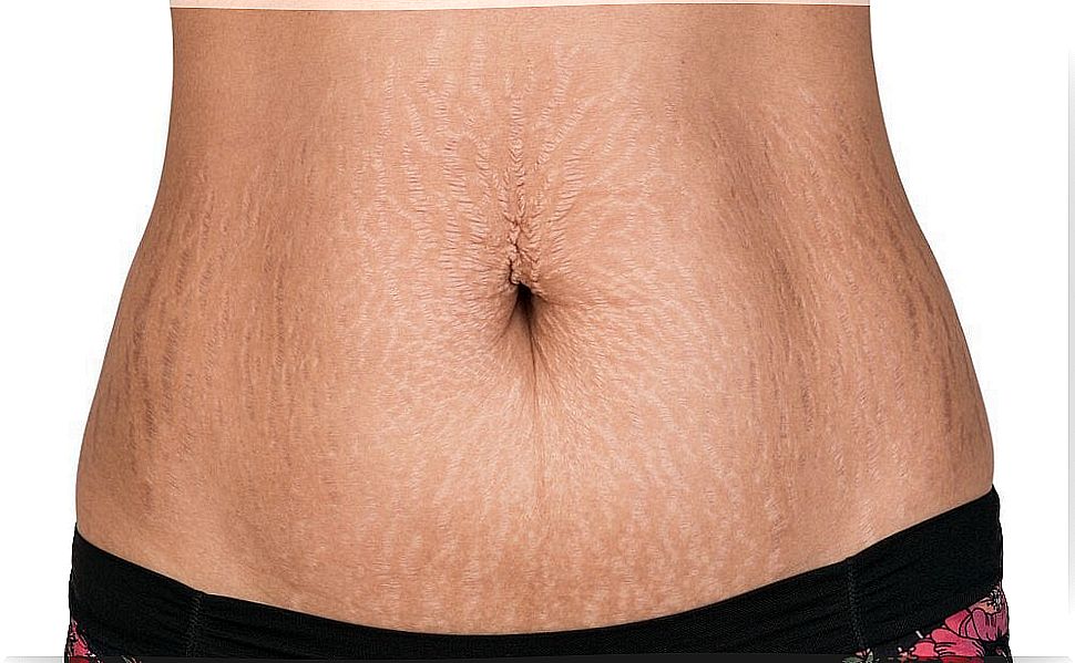 What helps against stretch marks on the skin?