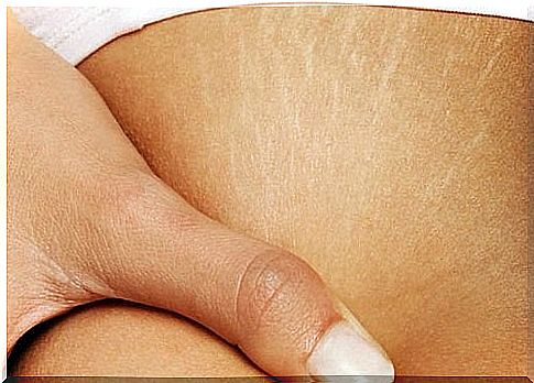 Improve the appearance of stretch marks on the skin