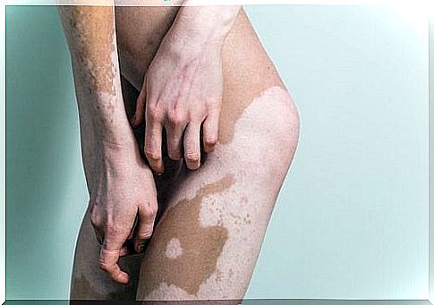 White Spots On The Skin: Can You Treat Vitiligo?